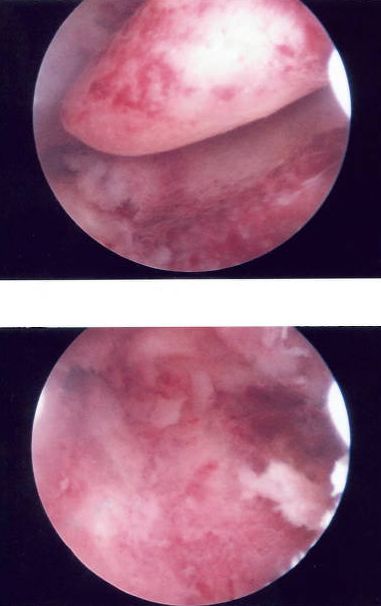 Uterine Polyp Removal before-and-after